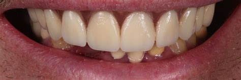 Zirconia Dental Implant Bridge