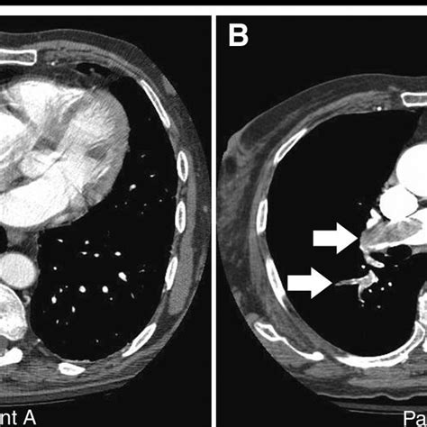 Transverse Contrast Material Enhanced Ct Images In Two Patients Arrows