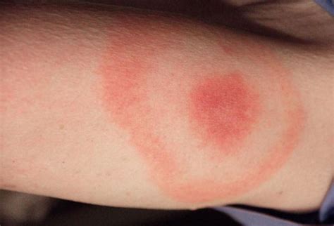 Picture Of Lyme Disease