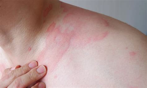 Allergy symptoms stock photo. Image of dermatology, male - 261187744