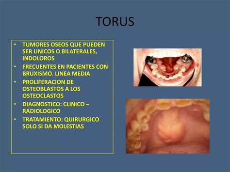 Tumores Benignos Y Malignos De Cavidad Oral Ppt