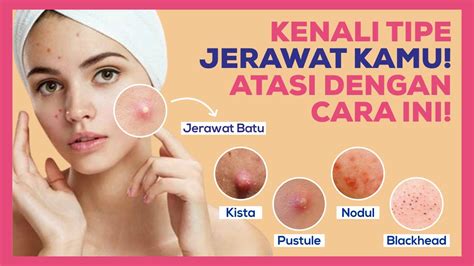 Jenis Jerawat Ini Paling Sering Muncul Atasi Jerawat Dengan Cara Ini