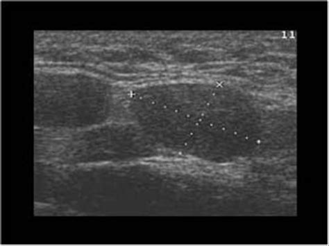 Head and Neck | 4.4 Lymph nodes : Case 4.4.1 Benign lymph nodes ...