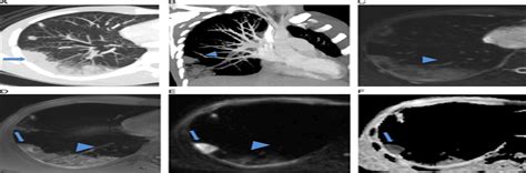 Initial Experience With The Use Of Diffusion Weighted Magnet Journal Of Thoracic Imaging