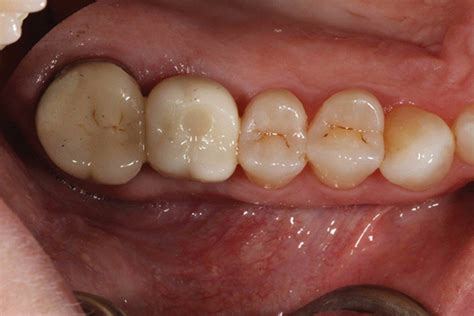 When To Choose Screw Retained Over Cement Retained Crowns 51 OFF