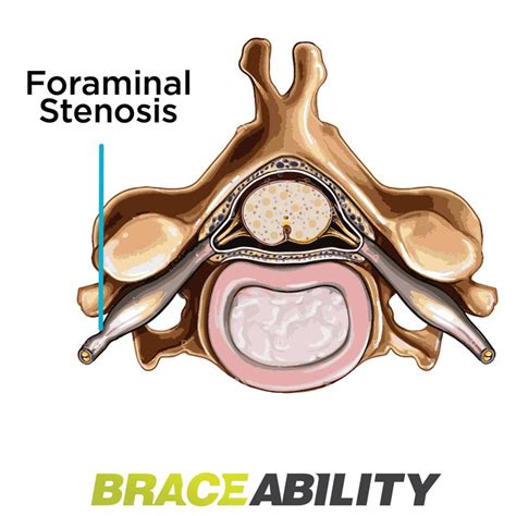 Lumbar Foraminal Stenosis