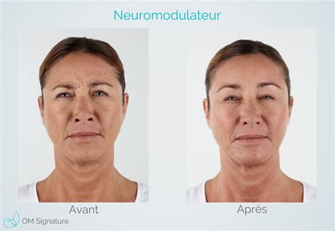 Injection Botox Xeomin Clinique Médico Esthétique à St Lambert