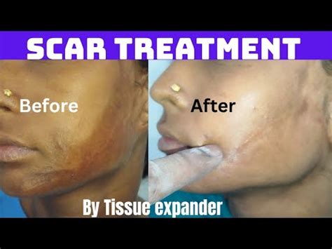 Scar Correction With Tissue Expander Treatment Of Scar Using Tissue