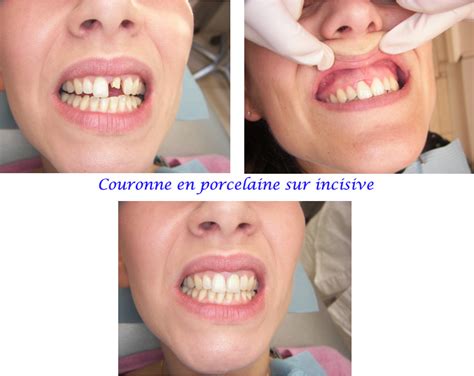 Les Couronnes C Ramiques Dentiste La D Fense