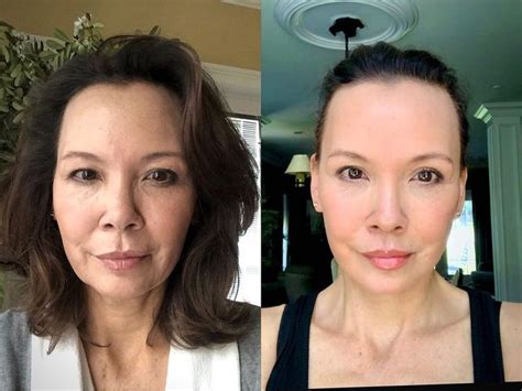 Deep Plane Facelift Before And After Dr Andrew Jacono Plastic