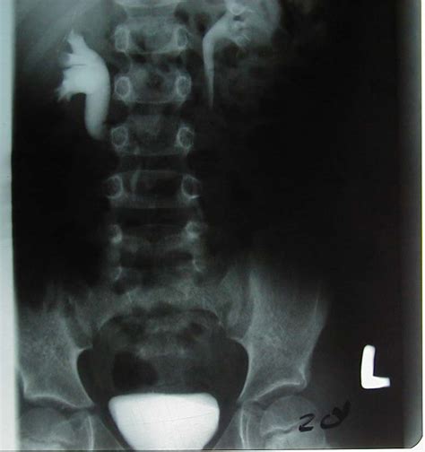 Intravenous Pyelogram Showed That The Upper Ureter Was S Shaped And Was