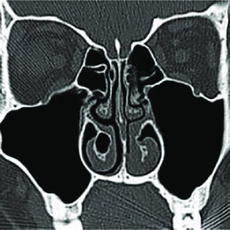 Serial Coronal Ct Scans Of The Paranasal Sinuses Showing A