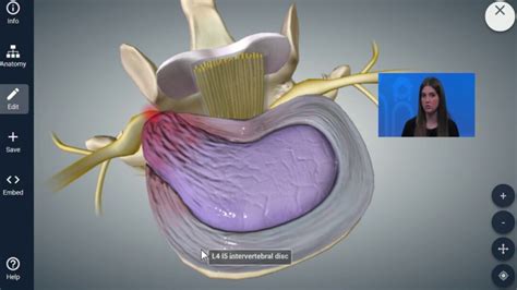 Types of Back Surgery - Health Channel