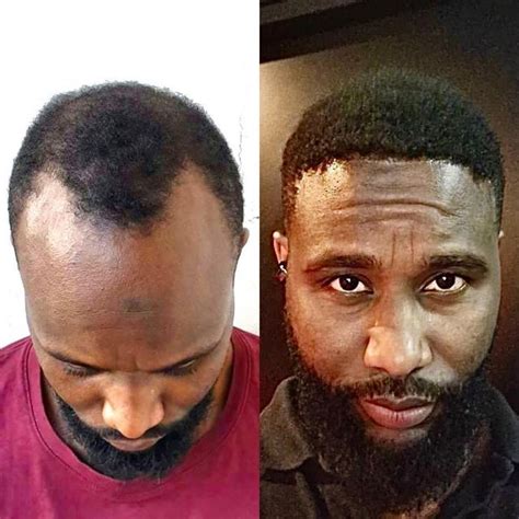 Asli Tarcan Health Tourism On Instagram Afro Hairtransplant After