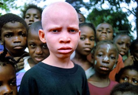 A vida dos negros albinos na África Castro Digital Bacabal MA