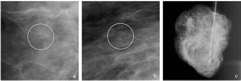 Figure 2 From The Impact Of Preoperative Breast MRI On Surgical