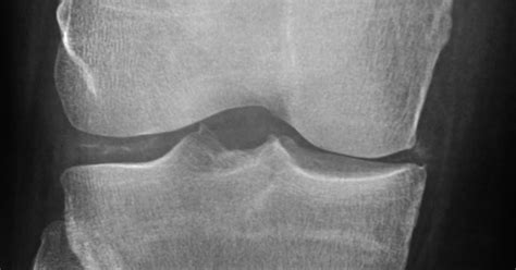 Daily Dose Chondrocalcinosis Knee