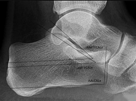 Radiographic measurements of the talus and calcaneus in the adult pes planus foot type ...