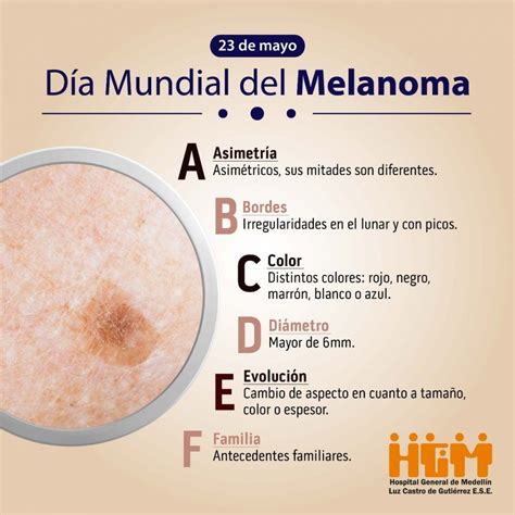 Melanoma Lunares Con Historia Visionarias