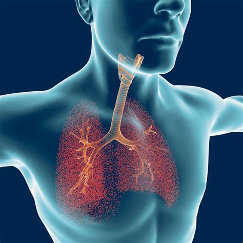 Bronchiectasis Symptoms and Signs - Bronchiectasis News Today