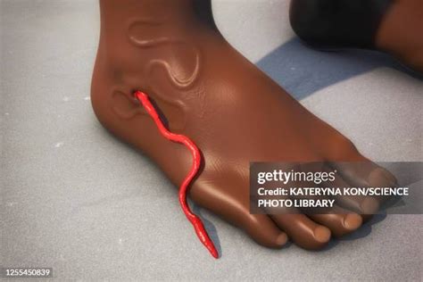 37 Guinea Worm Disease Stock Photos, High-Res Pictures, and Images ...