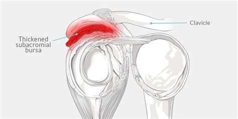 Shoulder Impingement Anatomy