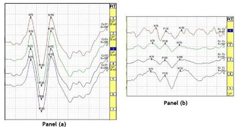panel  normal vep waveform showing p latency  amplitude