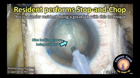 CataractCoach 1191 Resident Stop And Chop Cataract Case YouTube