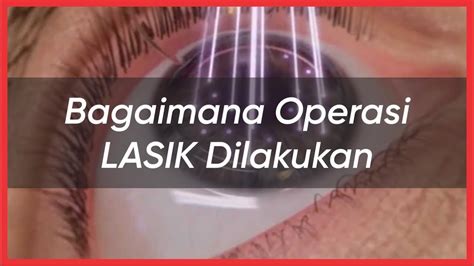 Bagaimana Operasi LASIK Pada Mata Minus Dilakukan YouTube