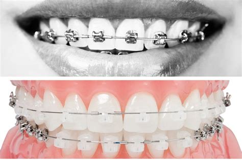 Disjunctor Dentar Sau Maxilar Rol Si Pret Dental Premier