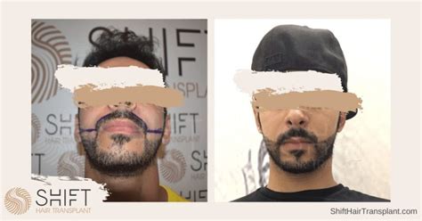 Beard Transplant Facial Hair Istanbul Turkey Costs Results