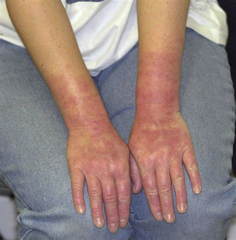 Contact urticaria, definition, causes, symptoms, diagnosis & prognosis