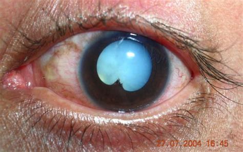 Pin On Ocular Damage