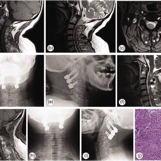 Preoperative Postoperative And Month Follow Up Radiographs Of The