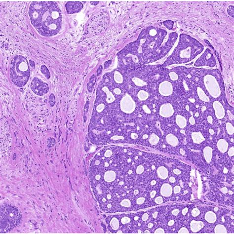 A Mucoepidermoid Carcinoma With Typical Admixture Of Mucous Download Scientific Diagram