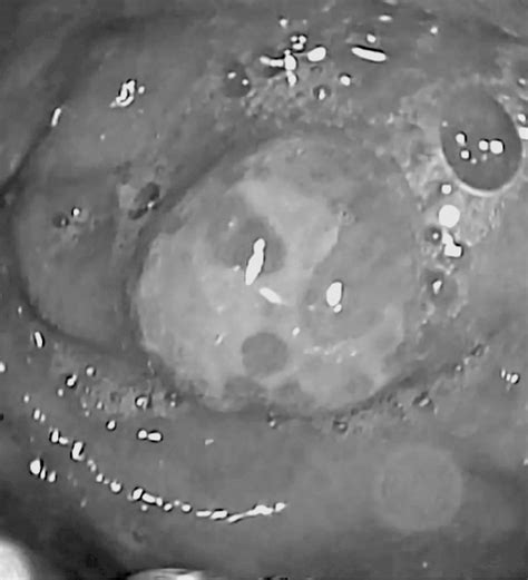 Esophagogastroduodenoscopy The Gastric Cardia Stump Exhibits A Download Scientific Diagram