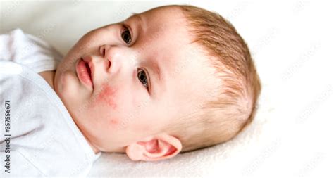 What Is Pediatric Eczema And When Should We See A Doctor