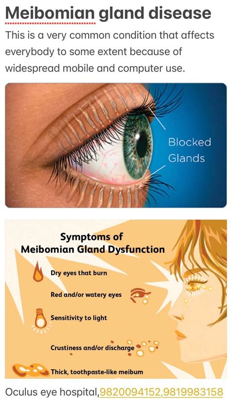 Meibomian Gland Dysfunction and Treatment - Welcome to OCULUS EYE ...