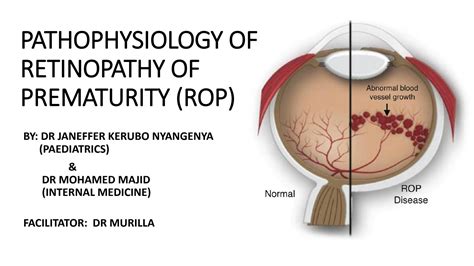 Solution Pathophysiology Of Retinopathy Of Prematurity Powerpoint