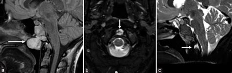 Current Management And Image Review Of Skull Base Chordoma What The Radiologist Needs To Know