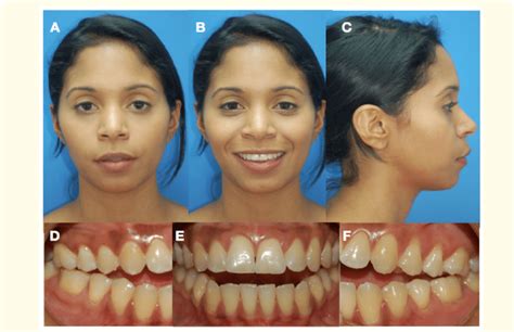 Initial Photos Showing Moderate Convex Profile And 7 Mm Anterior Open