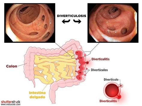 Diverticulosis Y Diverticulitis Síntomas Y Tratamiento