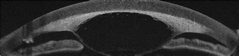 Figure 2 From Descemet S Membrane Detachment Following An Intracameral Injection Of Viscoelastic