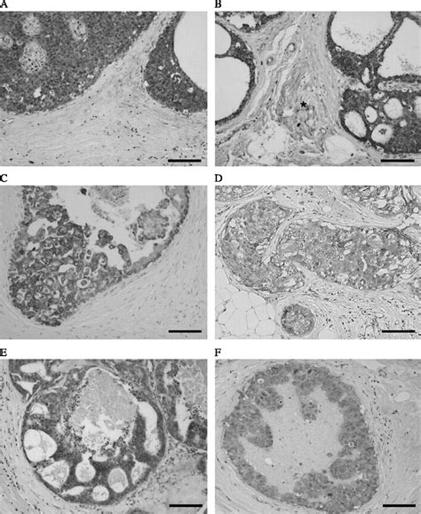 Intratumoral Concentration Of Sex Steroids And Expression Of Sex Steroid Producing Enzymes In