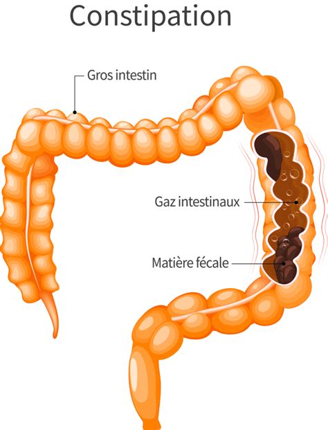 Quels Sont Les Différents Types De Constipation Information