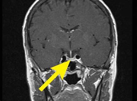 Meldung Hypophyse Hirnanhangdrüse Der zentrale Computer vieler