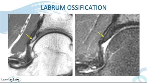 Hip Labrum Ossification Labral Abnormalities More Than Just Tears Part