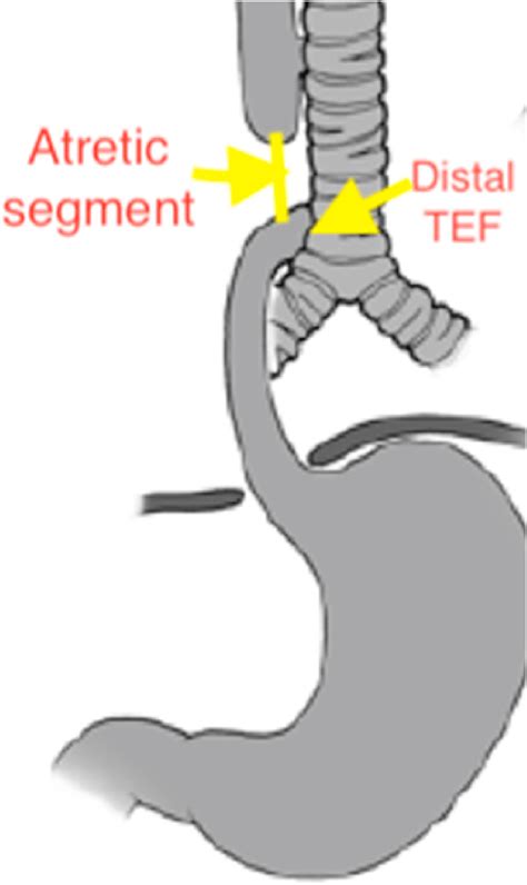 Drawing Figure Showing The Tracheoesophageal Fistula Before Closure And