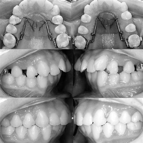 Jones Jig Appliance Maxillary Molar Distalization And Final Results