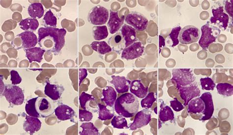 Fagocitosis En Leucemia Linfobl Stica Aguda B Con Reordenamiento Etv